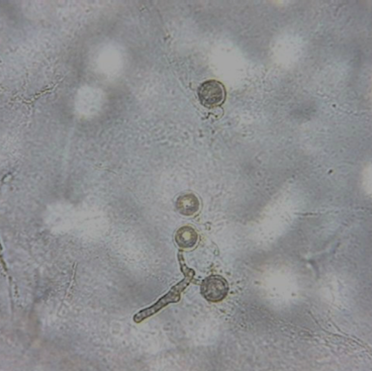 The pathogen survives as oospores, the sexual reproductive structure in infected tissue inside the spherical oogonium shown in the picture. Oospores is thought to serve as the primary inoculum for the disease.